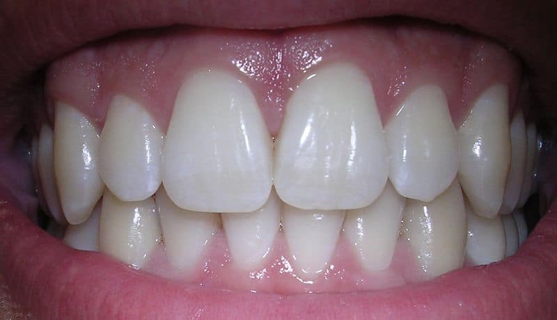 Teeth Falling Out? Your Confidence Might Be Crumbling