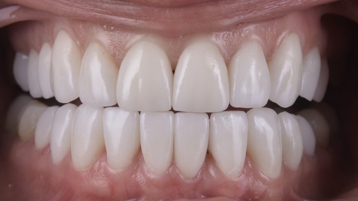 What Does It Mean to Dream About Teeth?